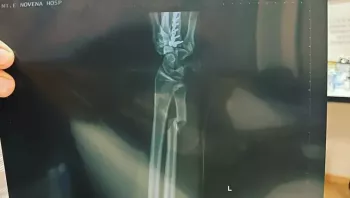 Alex Caceres partage une radiographie de son avant-bras cassé | UFC on ESPN+ 83