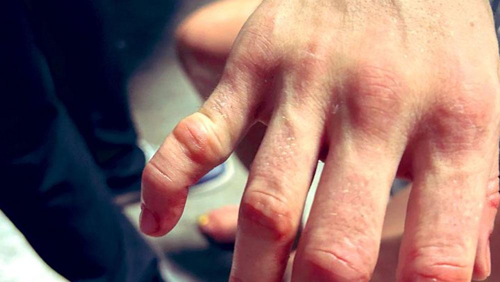 La blessure au doigt de Rose Namajunas était sérieuse | UFC Paris