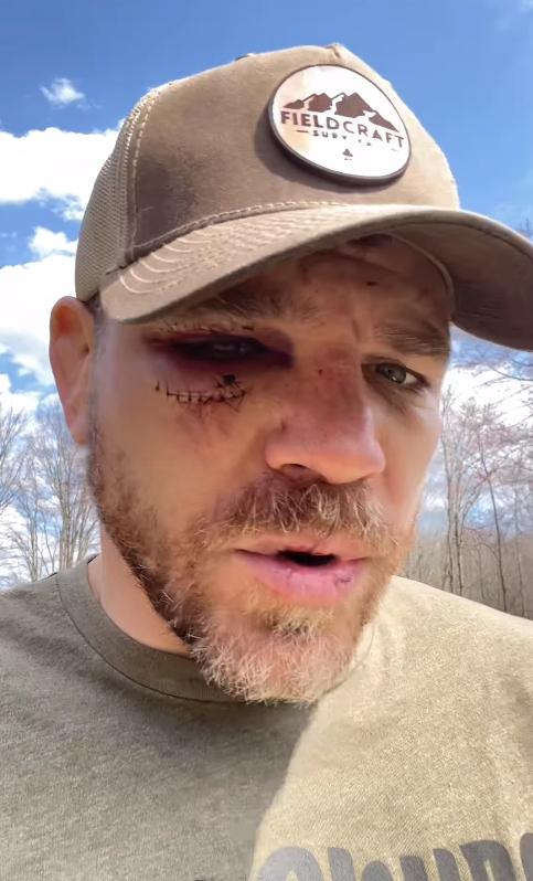 Jim Miller dévoile les blessures subies à l'UFC 300, dont 23 points de suture pour refermer une horrible coupure